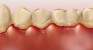 hoe ontstaat tandvlees ontsteking gingivitis